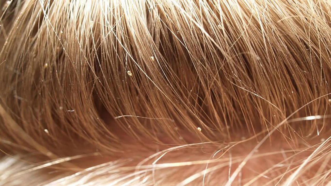Head Lice: What You Need To Know – Knoxville Institute of Dermatology