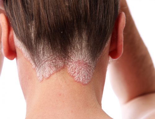 August is National Psoriasis Month